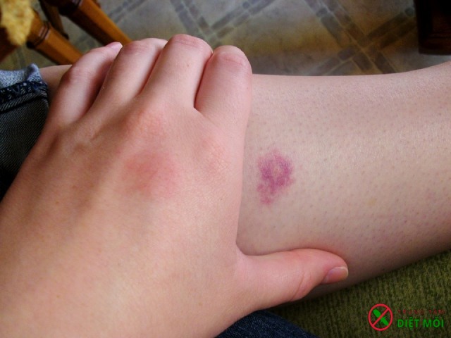 Tác hại khi bị côn trùng cắn