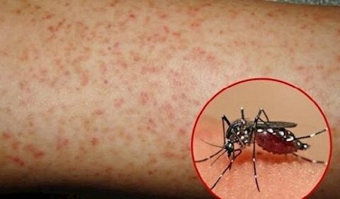 hiện tượng ngứa khi bị sốt xuất huyết
