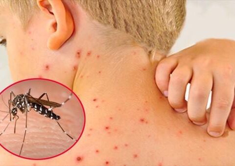 sốt xuất huyết ở trẻ em